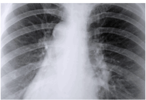 Radiografie plamani cu imagini